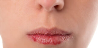 5 Penyebab Bibir Kering yang Wajib Anda Waspadai