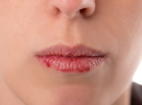 5 Penyebab Bibir Kering yang Wajib Anda Waspadai
