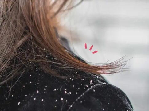 Mengatasi Rambut Berketombe fokusjabar.id