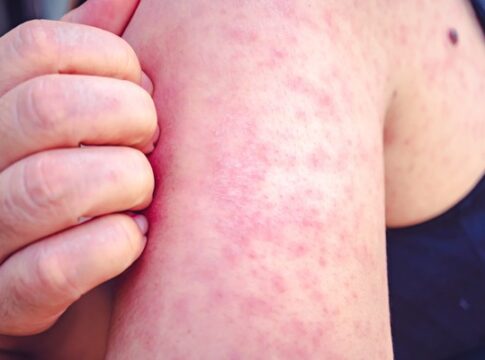 Penyakit Campak fokusjabar.id